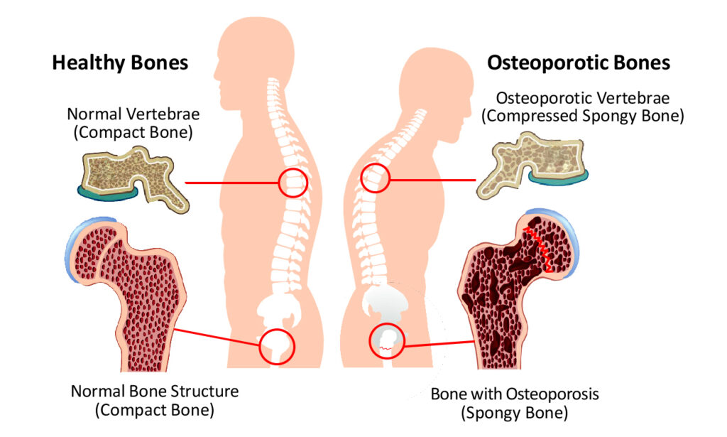 Osteoporosis Ways To Reduce Your Risk Simply Health And Wellness