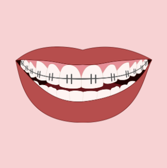 Light pink background. Image in the centre of a big smile with red lips and thin grey braces on the top row of teeth. 